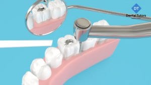 Dental crown preparation treatment